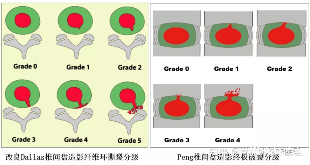 a:椎間盤內注射的造影劑流向纖維環;b:椎間盤內注射的造影劑流向終板