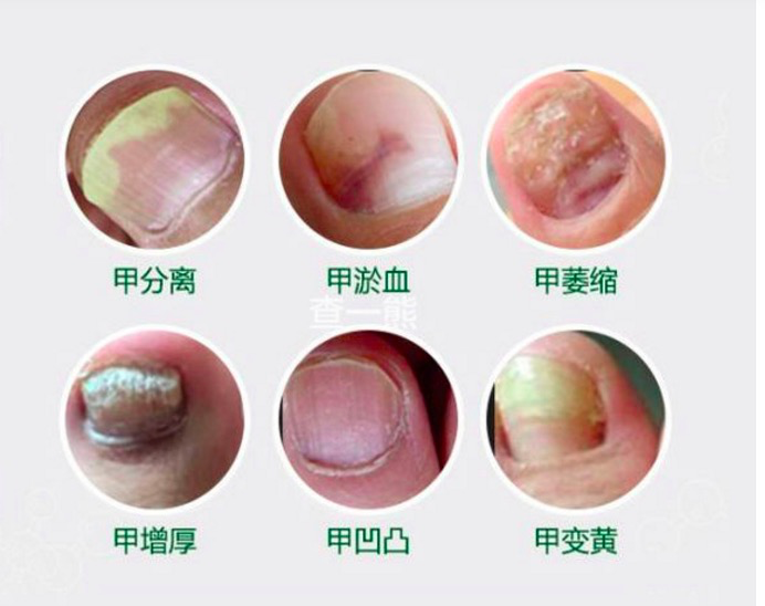 灰指甲严重到甲萎缩根除案例分享