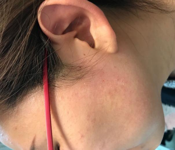 慧慧是位大二女生,这几年只要一到春天,桃花盛开的时候,面部皮肤就