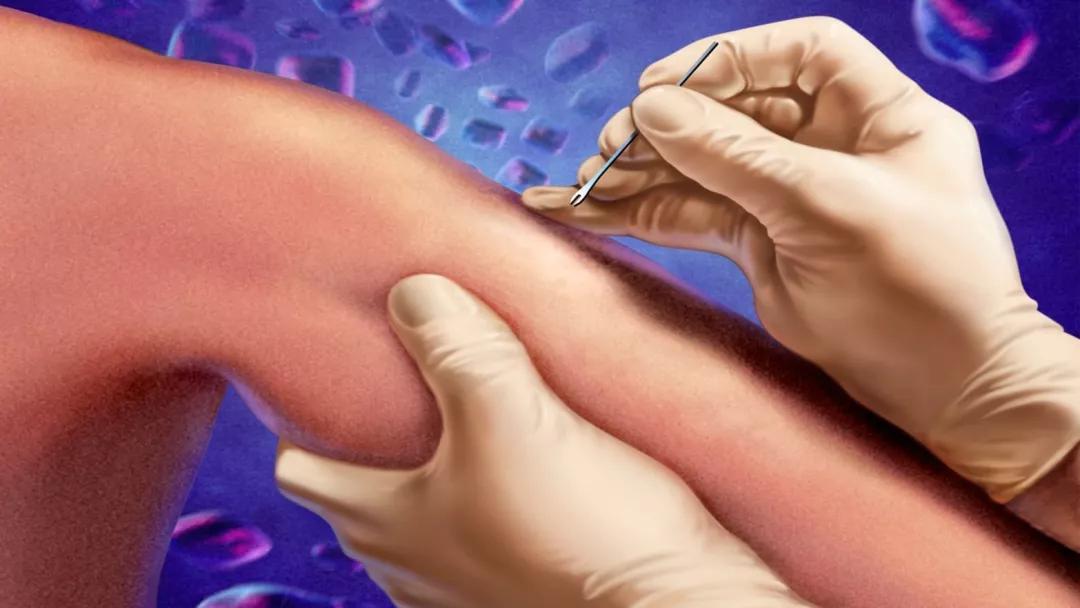 关于天花疫苗的故事,你听过的版本只说对了一半