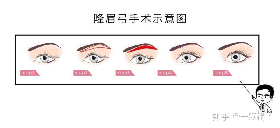 眉弓系列干货|想使眼睛更深邃,眼部更立体?改善眉弓看这里! - 知乎