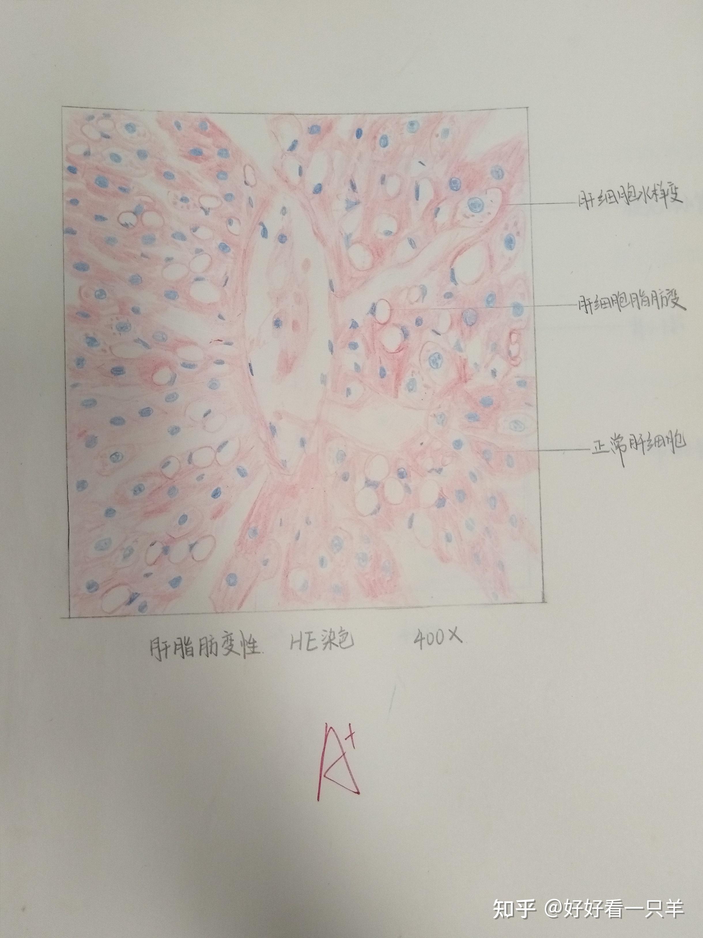 病理绘图红蓝铅笔图片