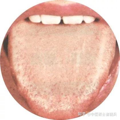 史上最全高清舌诊图谱,堪比教科书(收藏篇) - 知乎