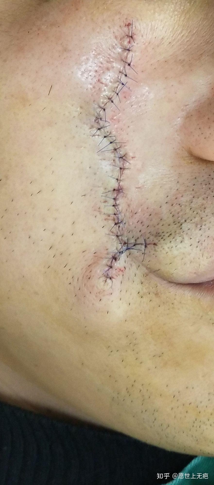 减张器对疤痕的影响(如何选择减张器) - 知乎