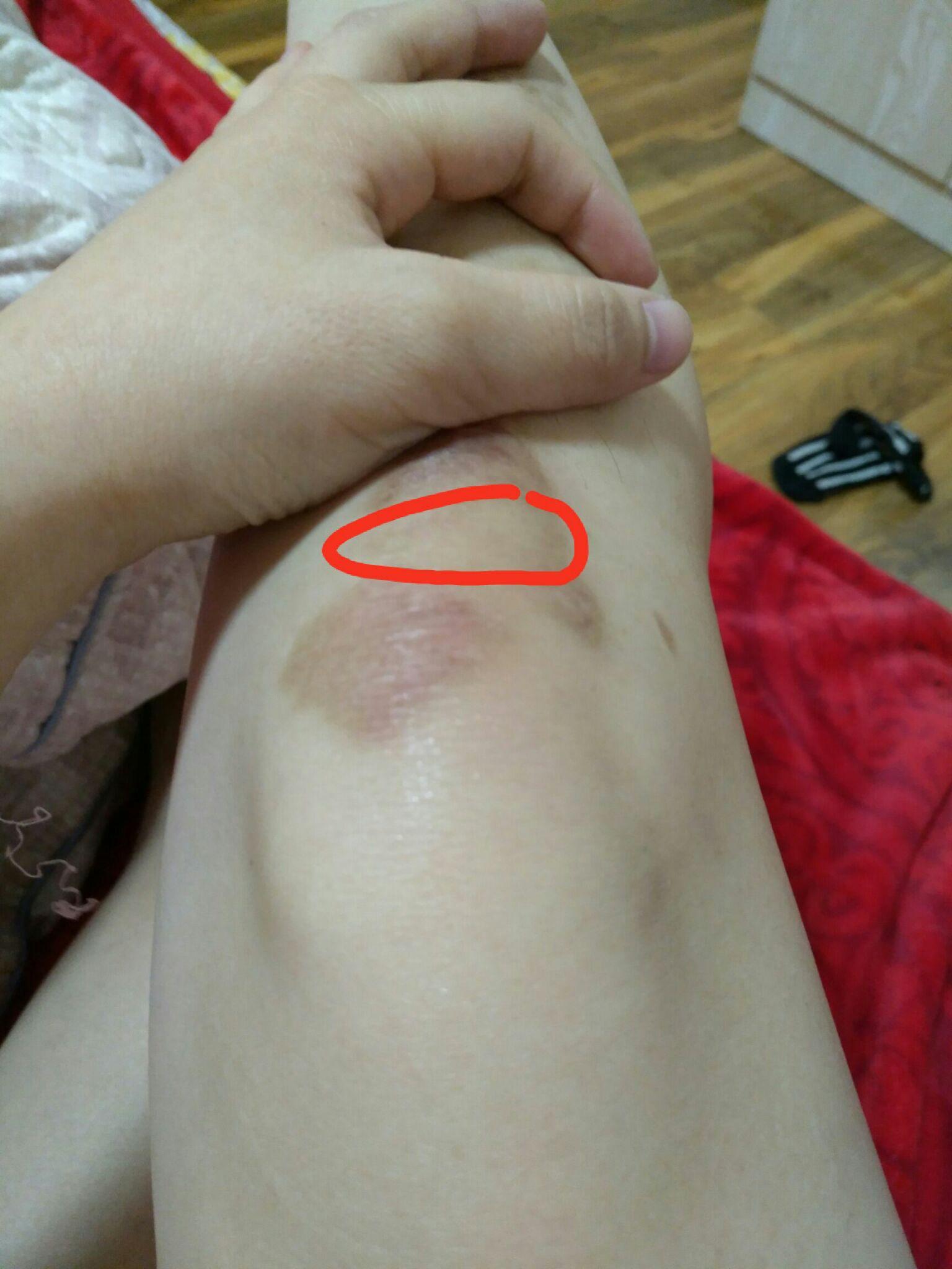 求解如何治疗膝盖擦伤留下大面积疤痕