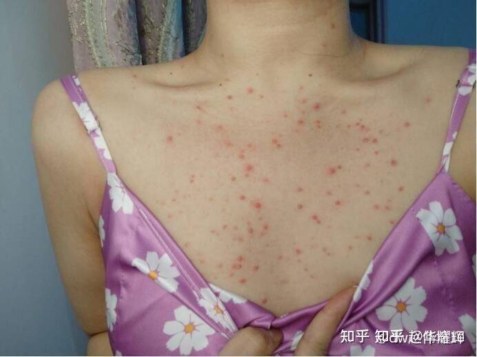 背上全是痘痘痘印怎么办? 内附祛痘方法!