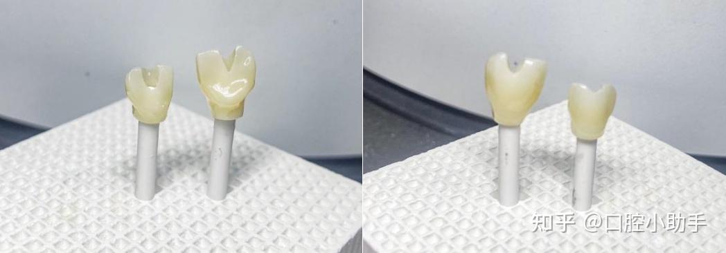 病例鉴赏|美学区贴面式个性化基台种植与天然牙联合修复一例 - 知乎