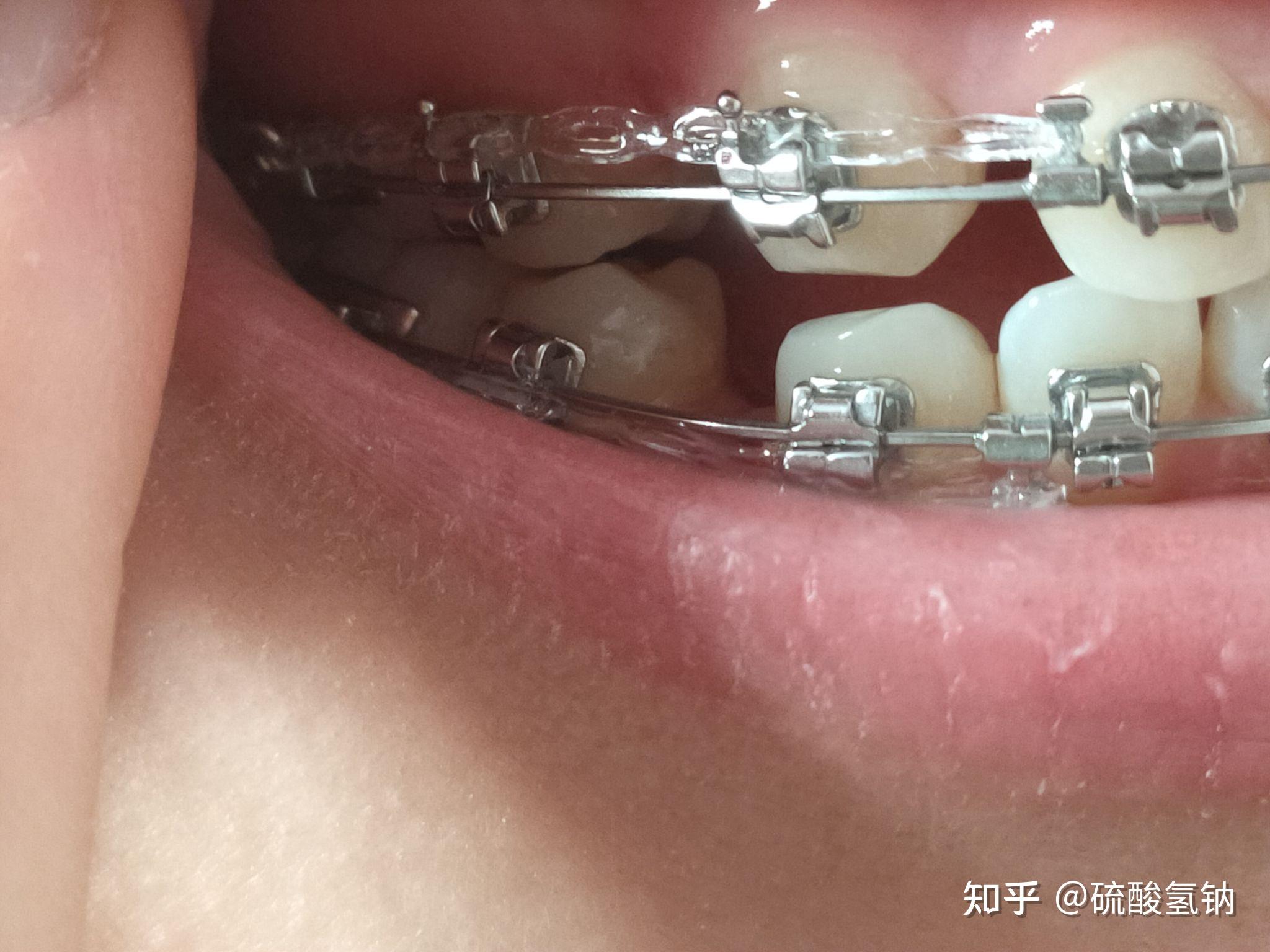上橡皮链,下牙上了个很细的钢丝,医生说下牙不太齐了,要先排齐再收缝