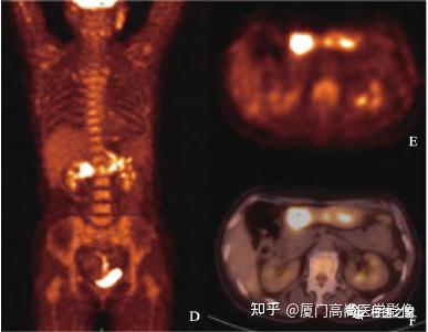 【高尚科普】胃MALT淋巴瘤的PET/CT诊断应用 - 知乎