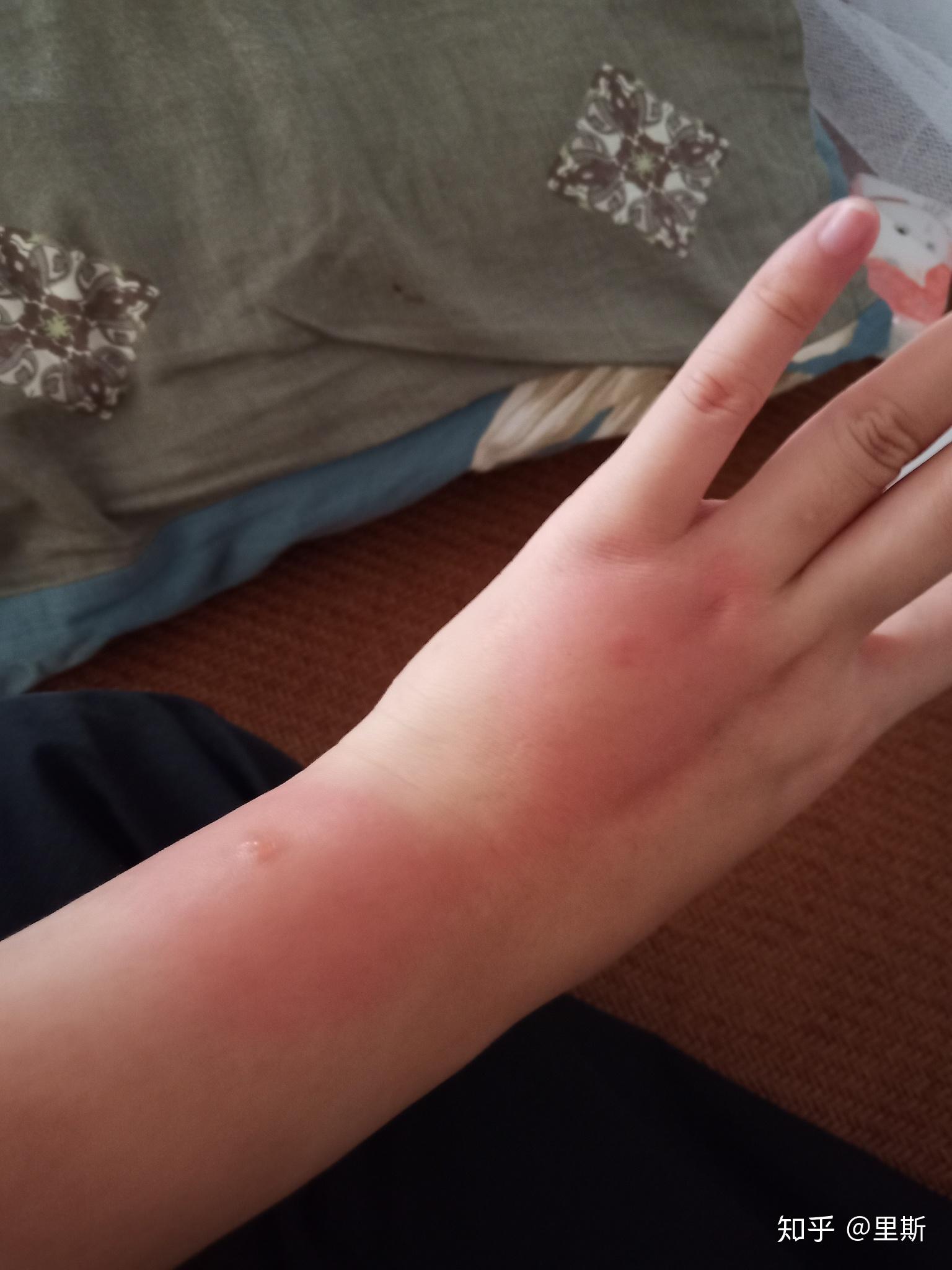 蚊子咬后肿大包之前没有这个状况什么原因