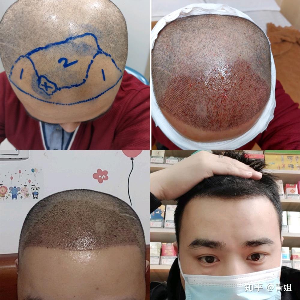 分享上海的植发机构和医生第三弹，看看植发效果如何？ - 知乎