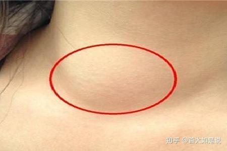 首大计成:造成颈部囊性病变原因有哪些?