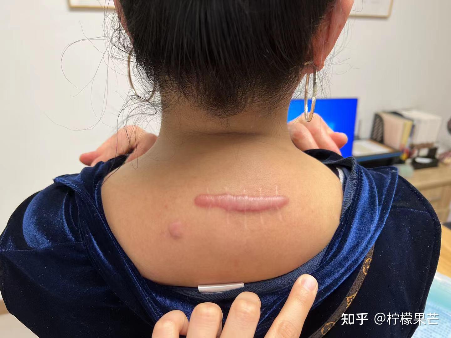 分离皮肤后直接将脂肪瘤切除,最后缝合切口就可以了