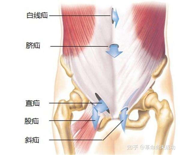 疝囊从腹壁下动脉内侧腹股沟三角区突出者为直疝,多见于老年男性,常