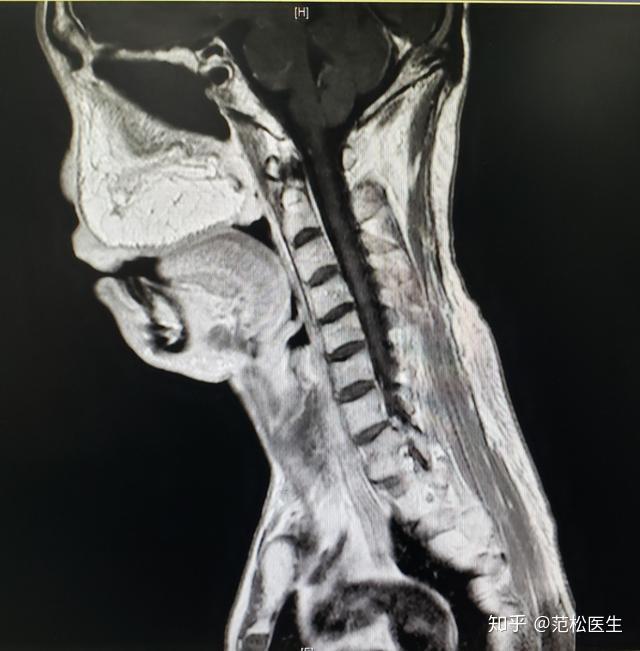 病例分享丨鼻咽癌放疗诱导的左上颌颅底骨肉瘤 - 知乎