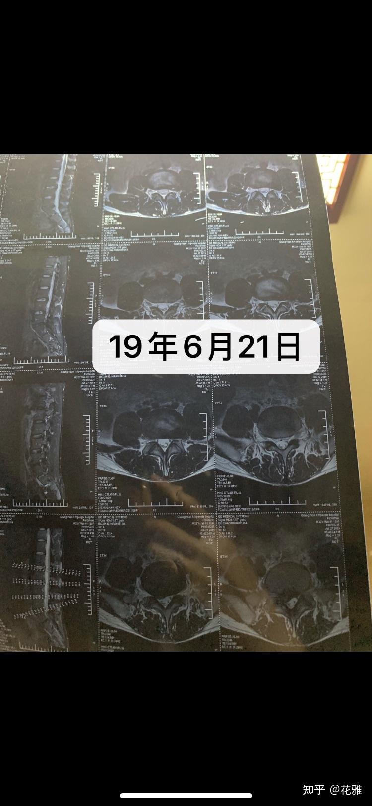 9个月,我的严重腰脱自愈了
