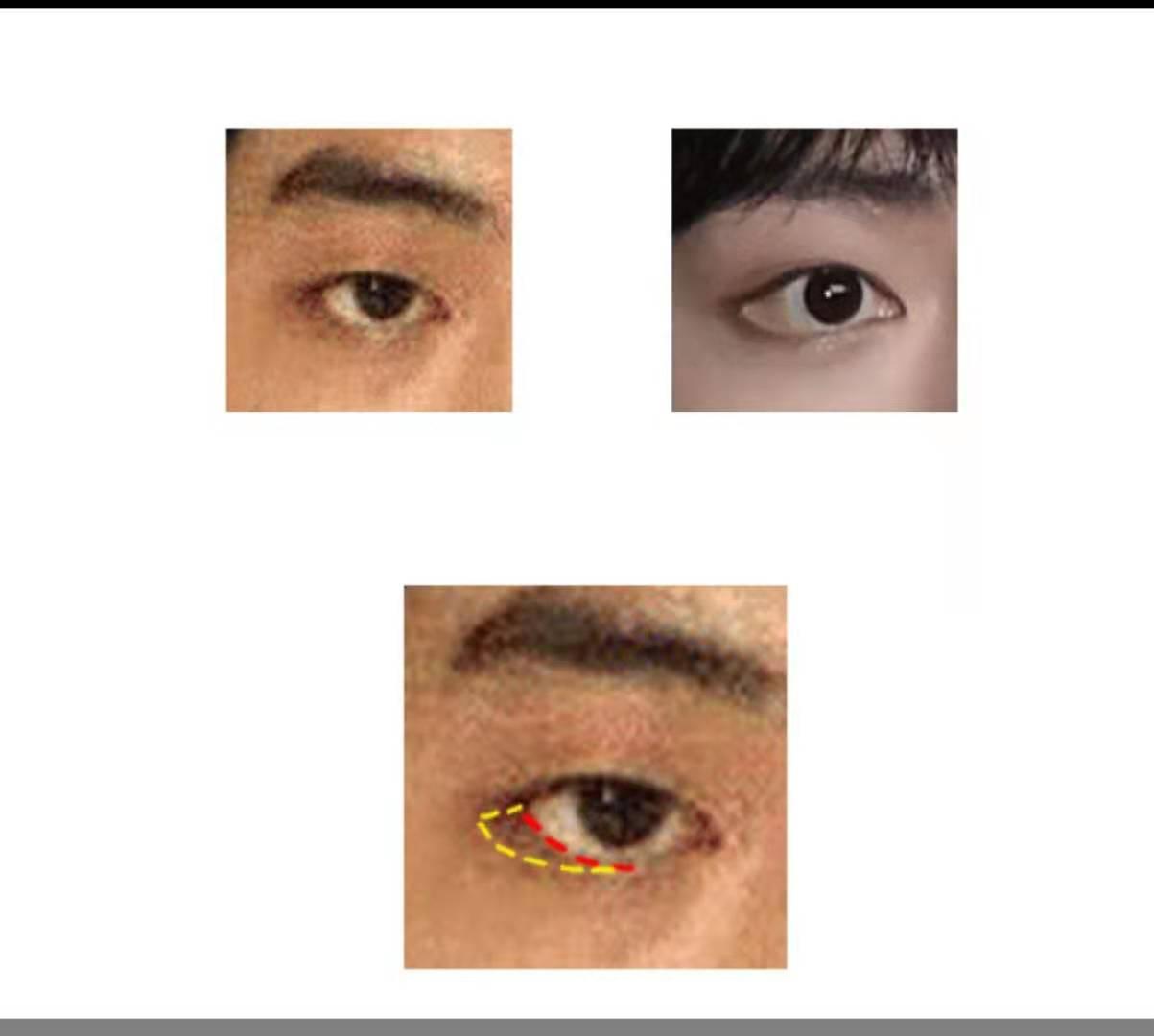 图片详解全切双眼皮全过程（含恢复过程） - 知乎