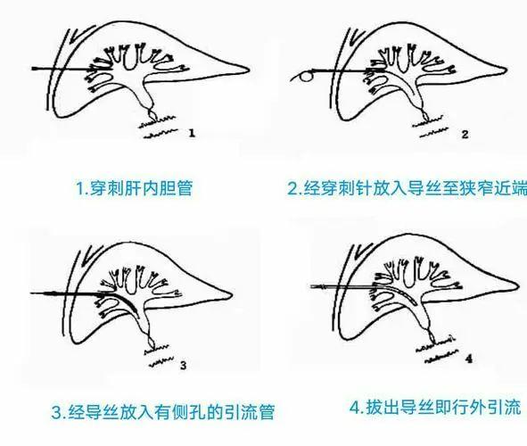 在目前临床医学治疗中,我们最常见,应用最广的黄疸治疗手段就是ptcd外