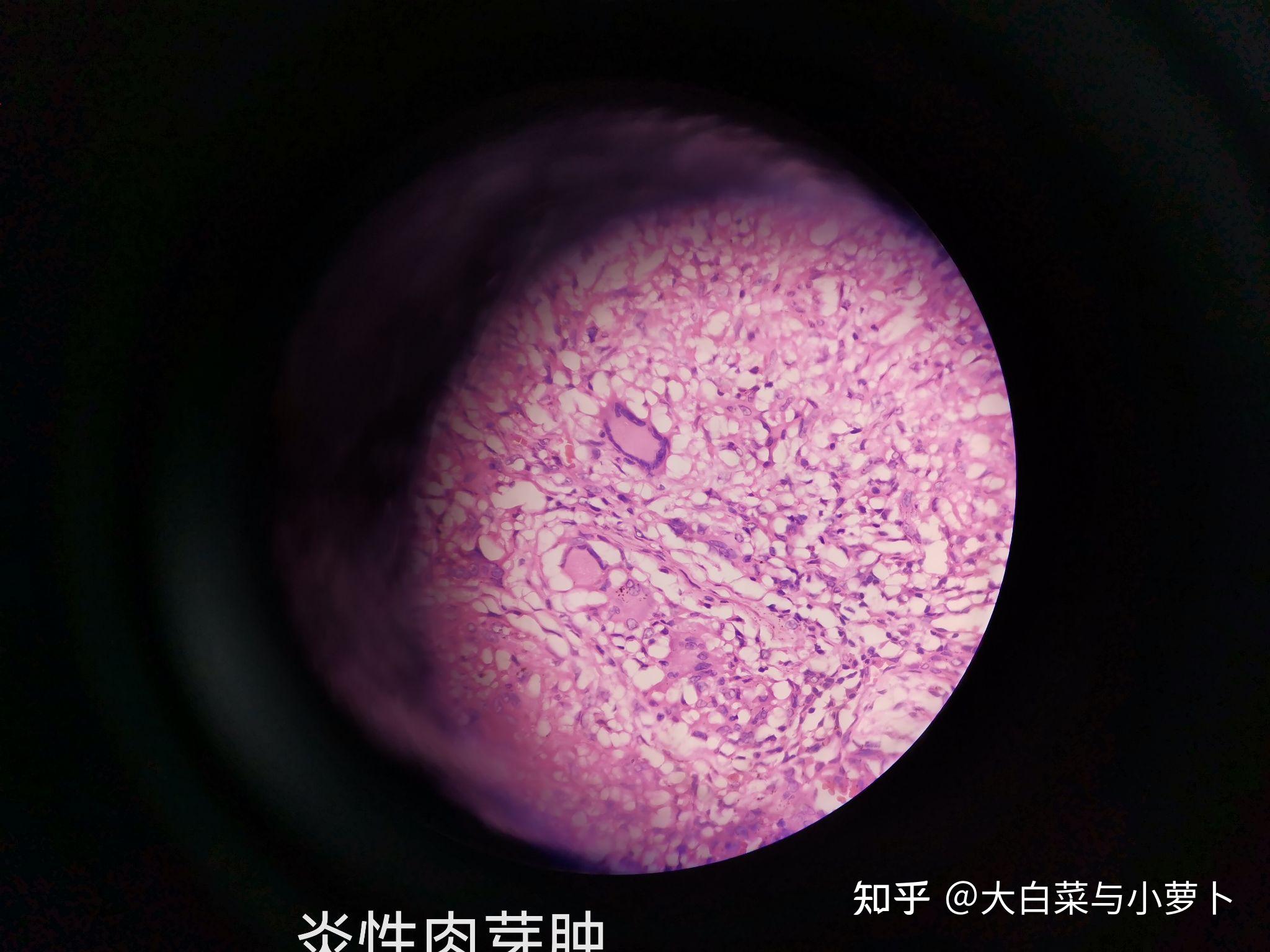 有多核鉅細胞和單核巨噬細胞形成的結節狀病灶—朗格漢斯細胞.