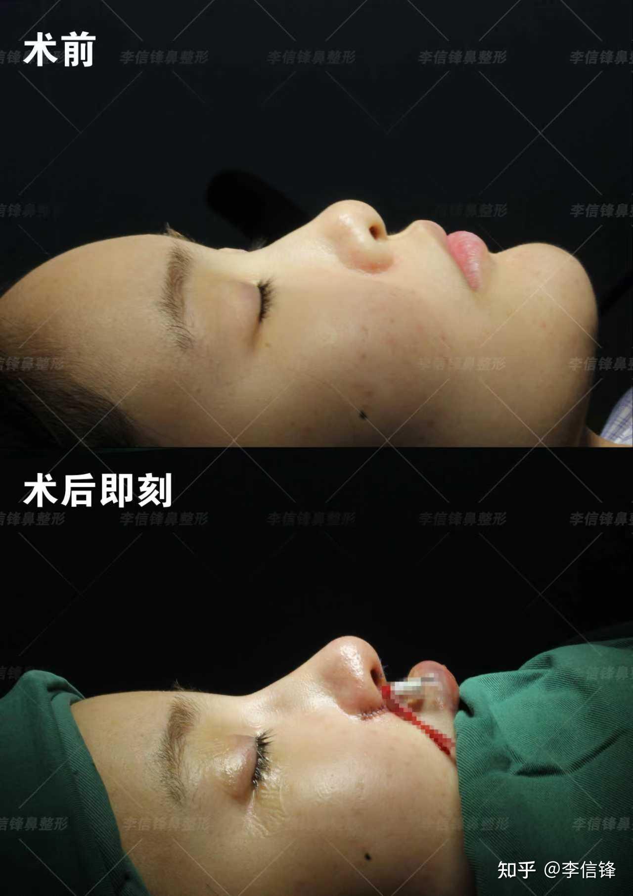 初鼻鼻综合-塌鼻、鼻头圆钝、漏鼻孔,鼻基底凹陷改善,术后即刻对比~ - 知乎