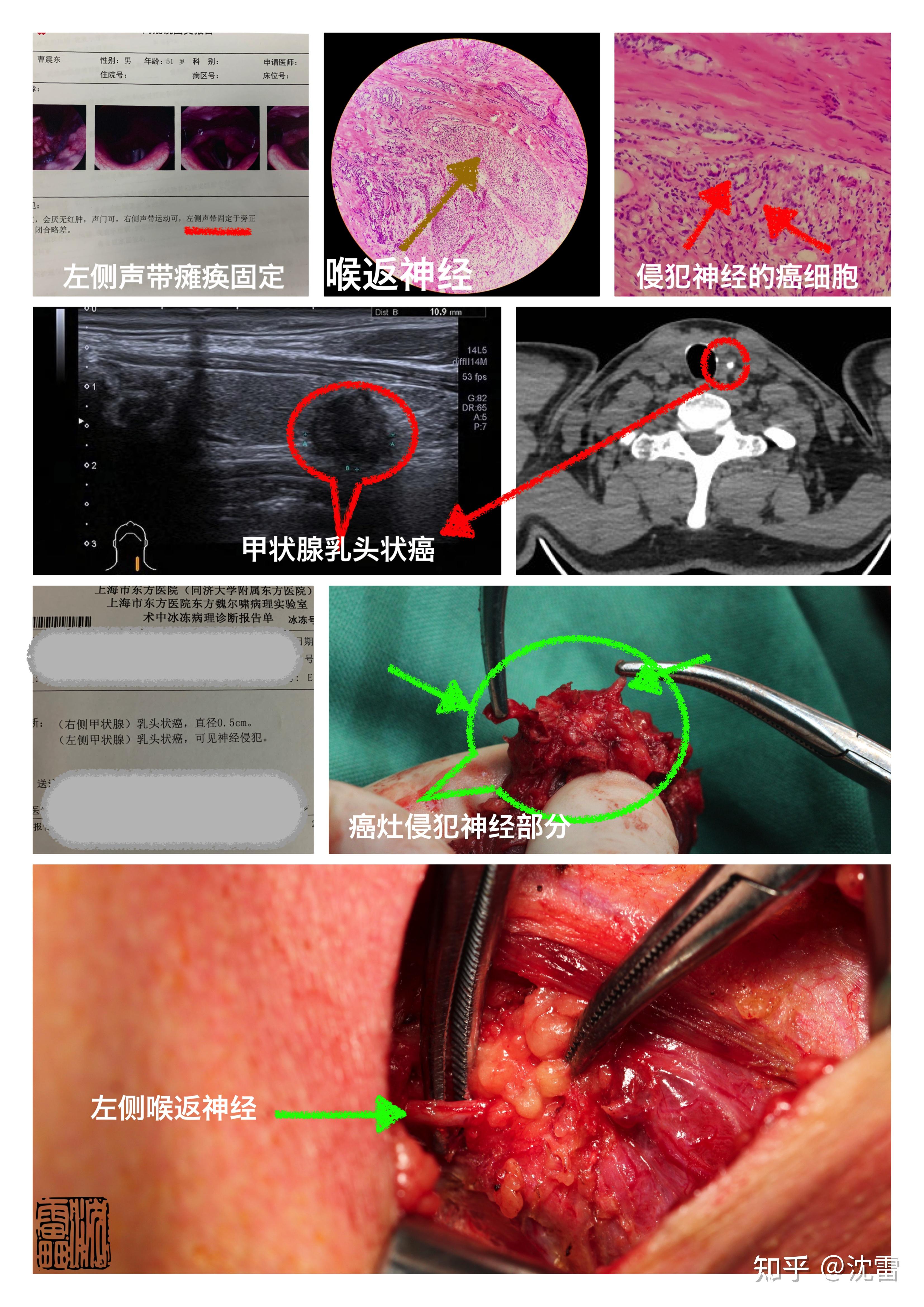 基于甲状腺手术双侧喉返神经损伤之解剖复习临床应对