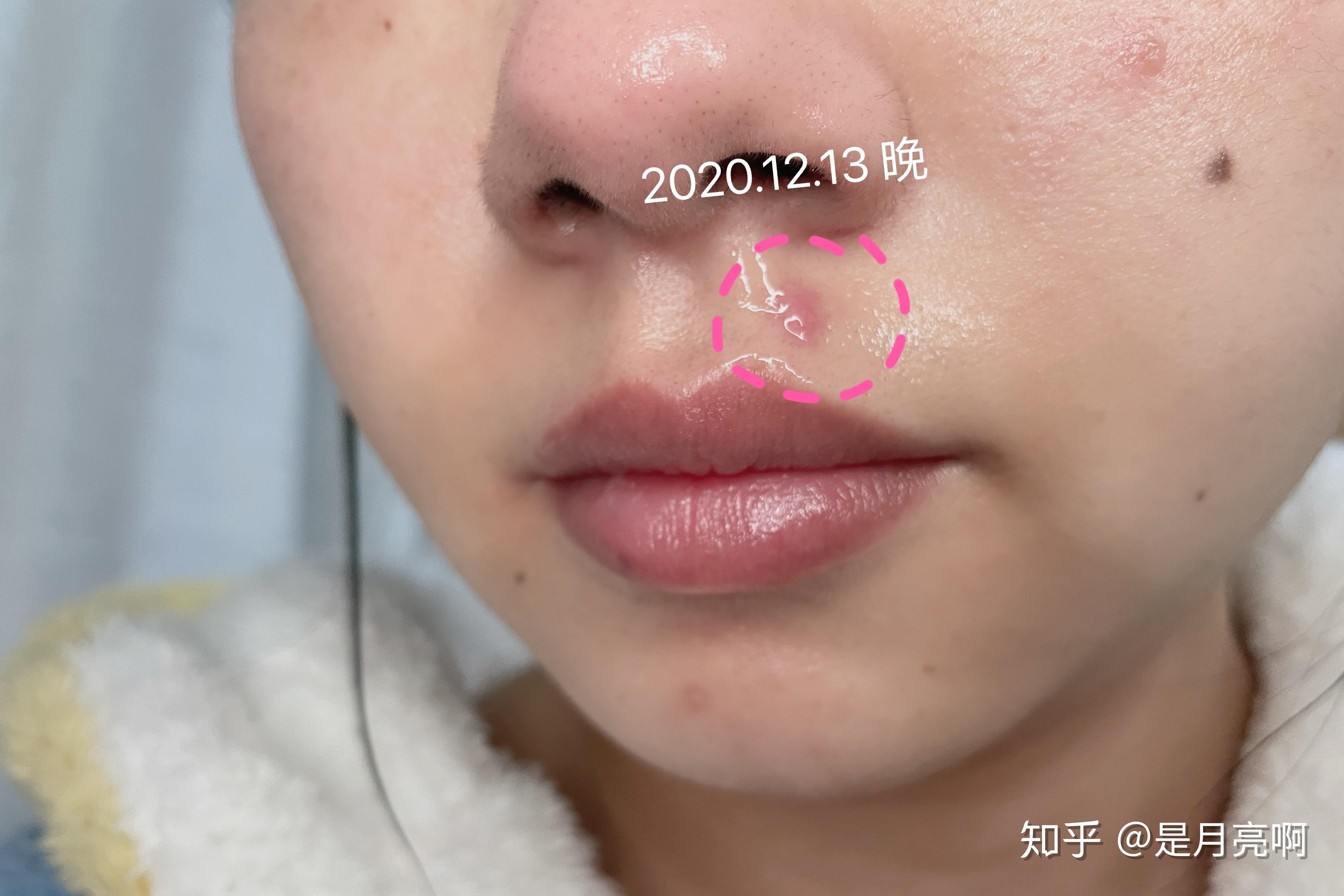 人中左侧唇峰上侧切痣全过程术前准备术后恢复详细记录