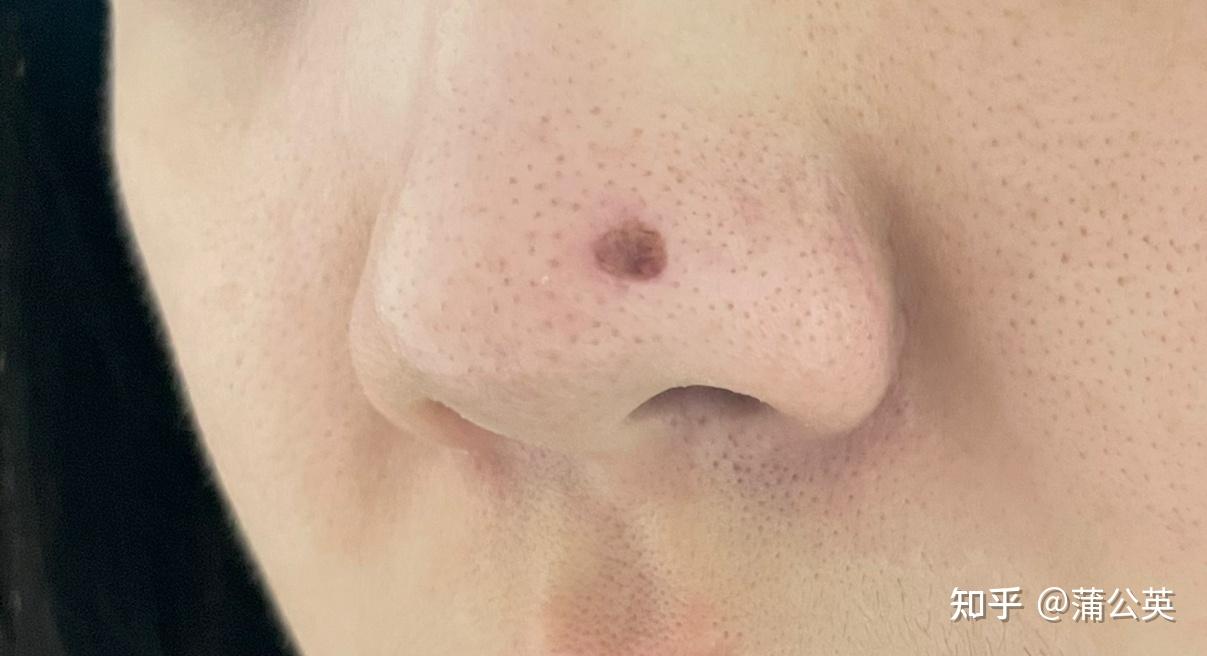 血管瘤蜘蛛痣电灼激光治疗