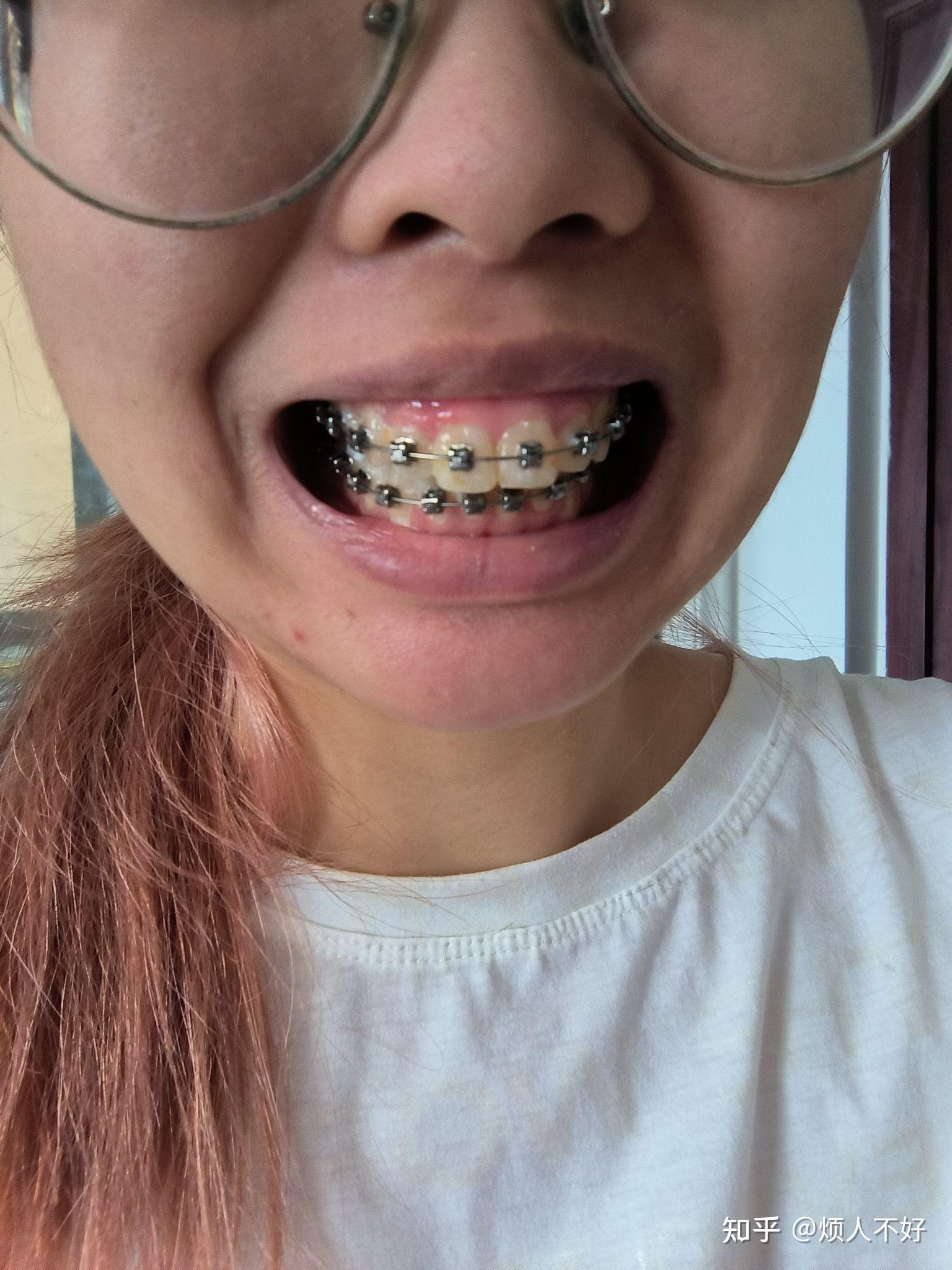 牙齿矫正2(龅牙)