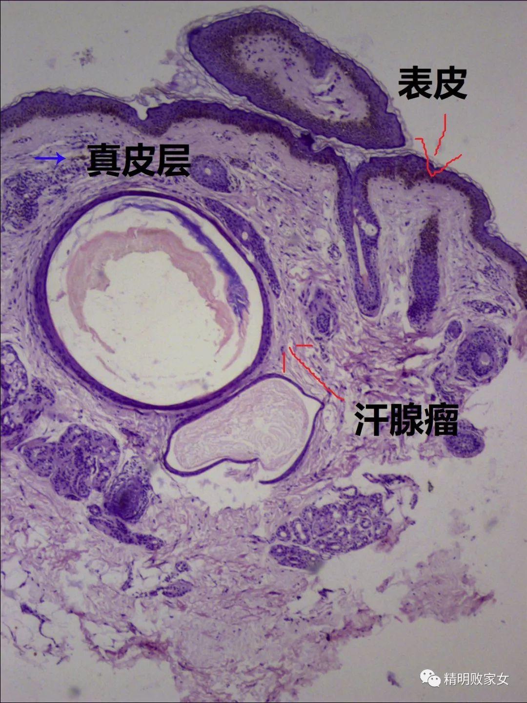 闭口粉刺怎么形成的?