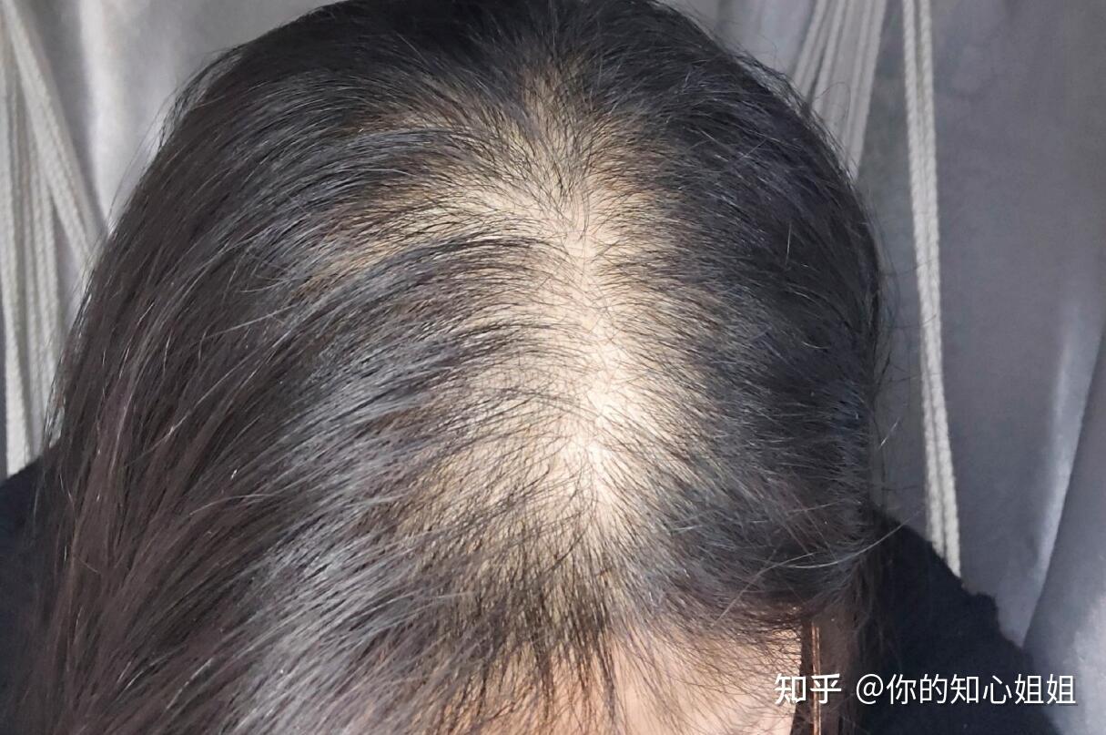 一名脱发患者的改善经历(有更新) - 知乎
