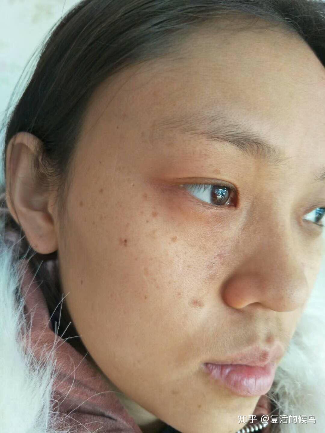 记录斑点去除的的过程