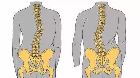 有一種痛叫脊柱側彎