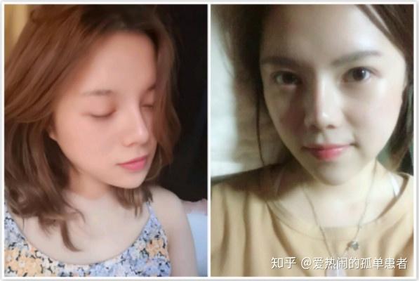 北京亲妈鼻自然直鼻测评