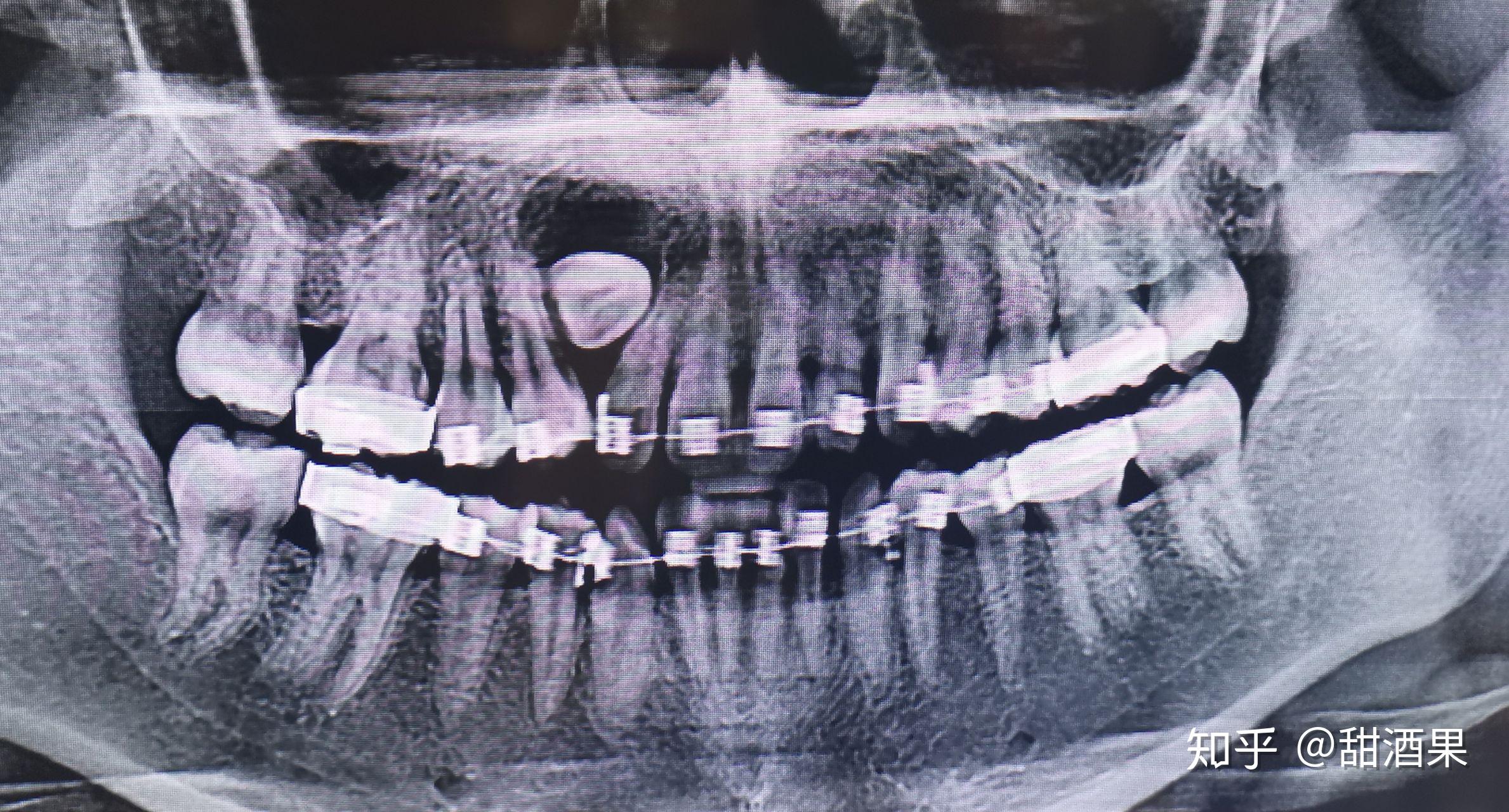 含牙囊肿影像学图片