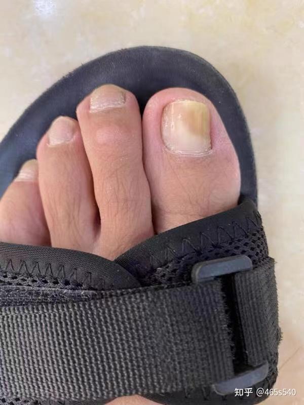 后来指甲开始变厚变浑浊,我尝试过醋泡蒜,风油精涂脚,还试过拔甲,拔甲