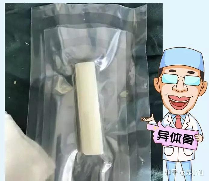 想用异体骨做鼻综合这些事先了解一下