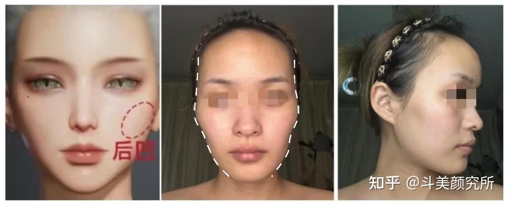 面颊凹陷的原因是什么？如何才能有效改善