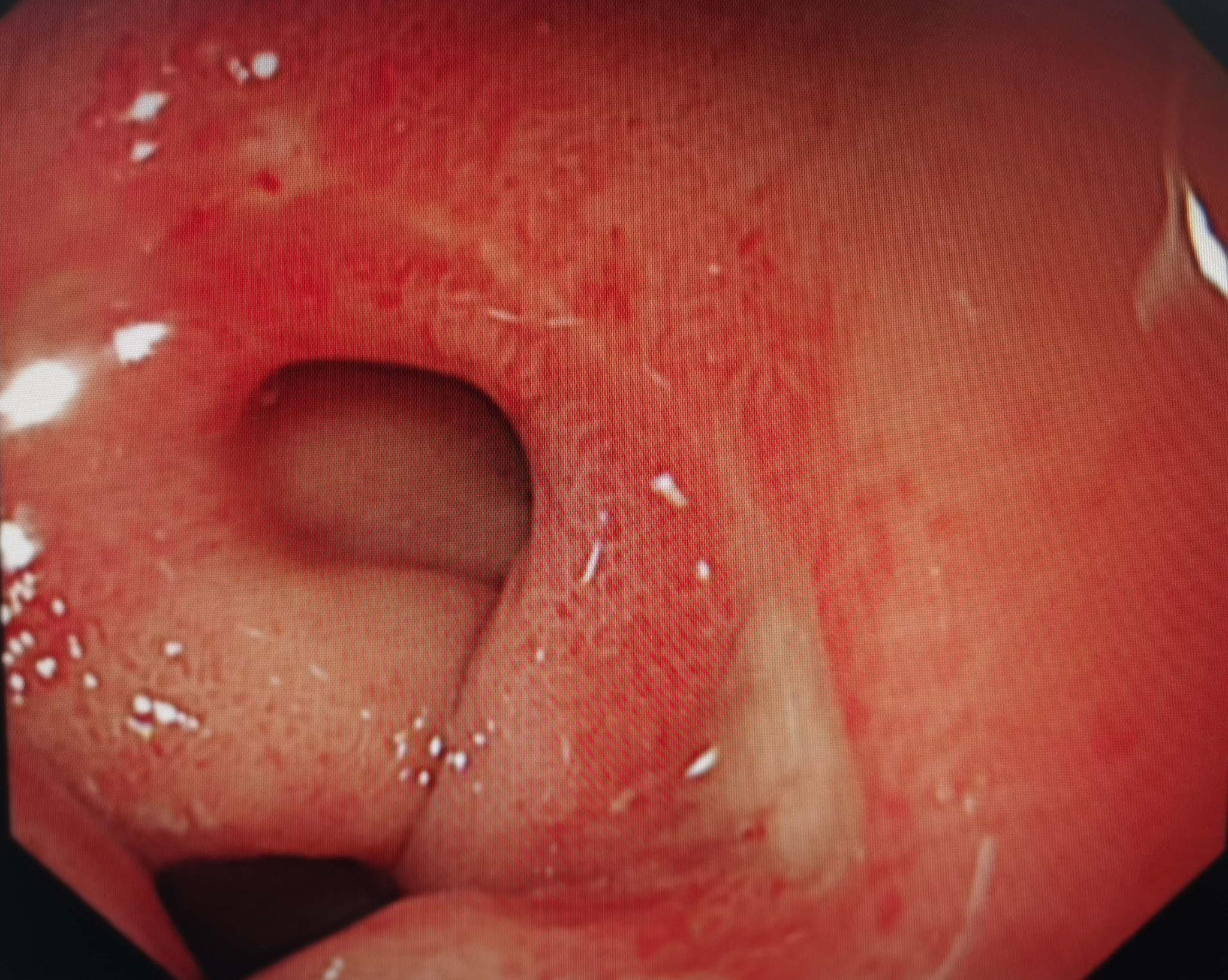 十二指肠球部"假性憩室"-如果内镜医生不注意,会穿孔的存在