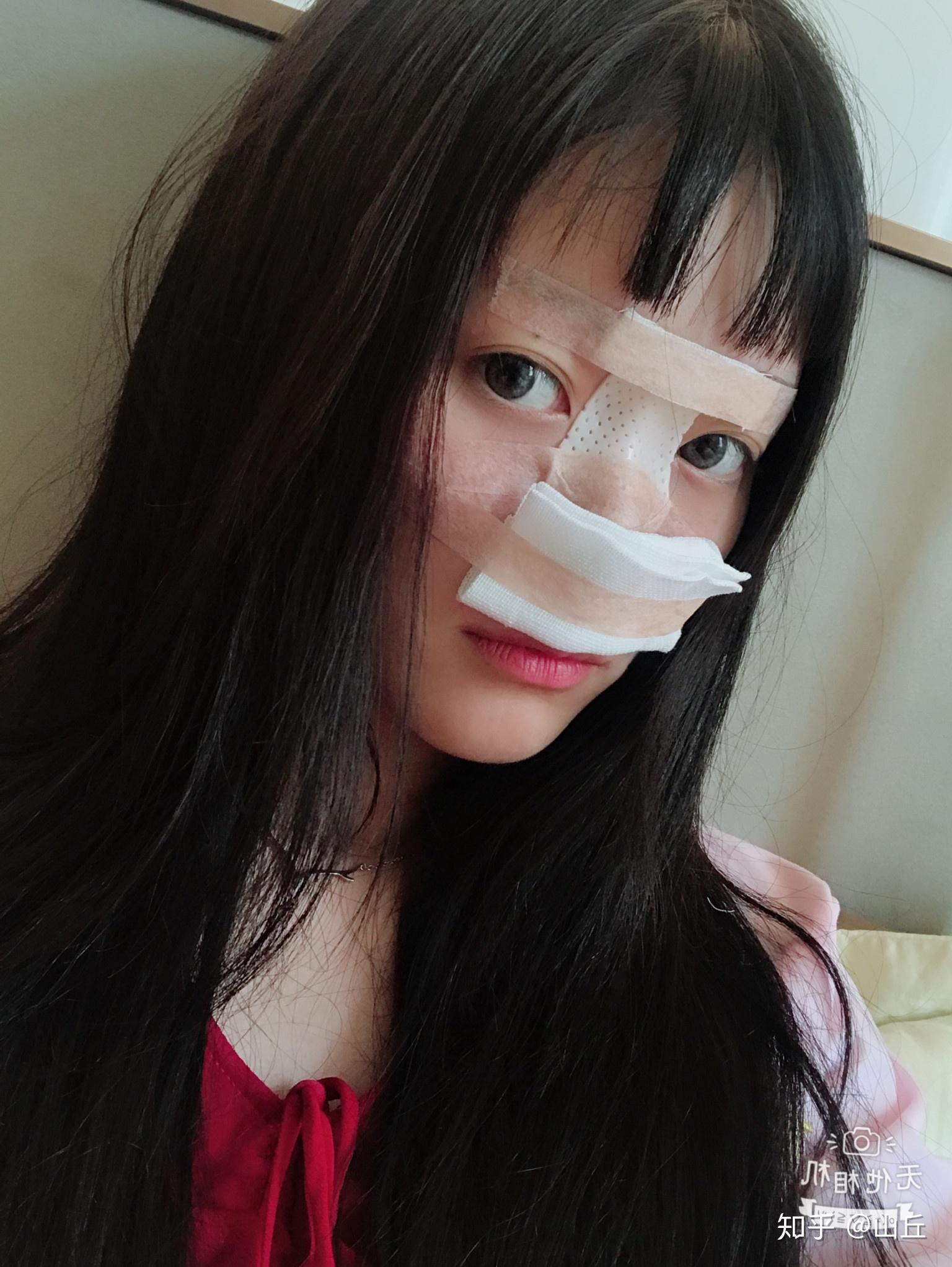 这是术后的第二天,为保护鼻子,被纱布包着,鼻子还是红肿和疼的