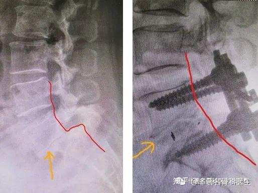 腰椎滑脱8年