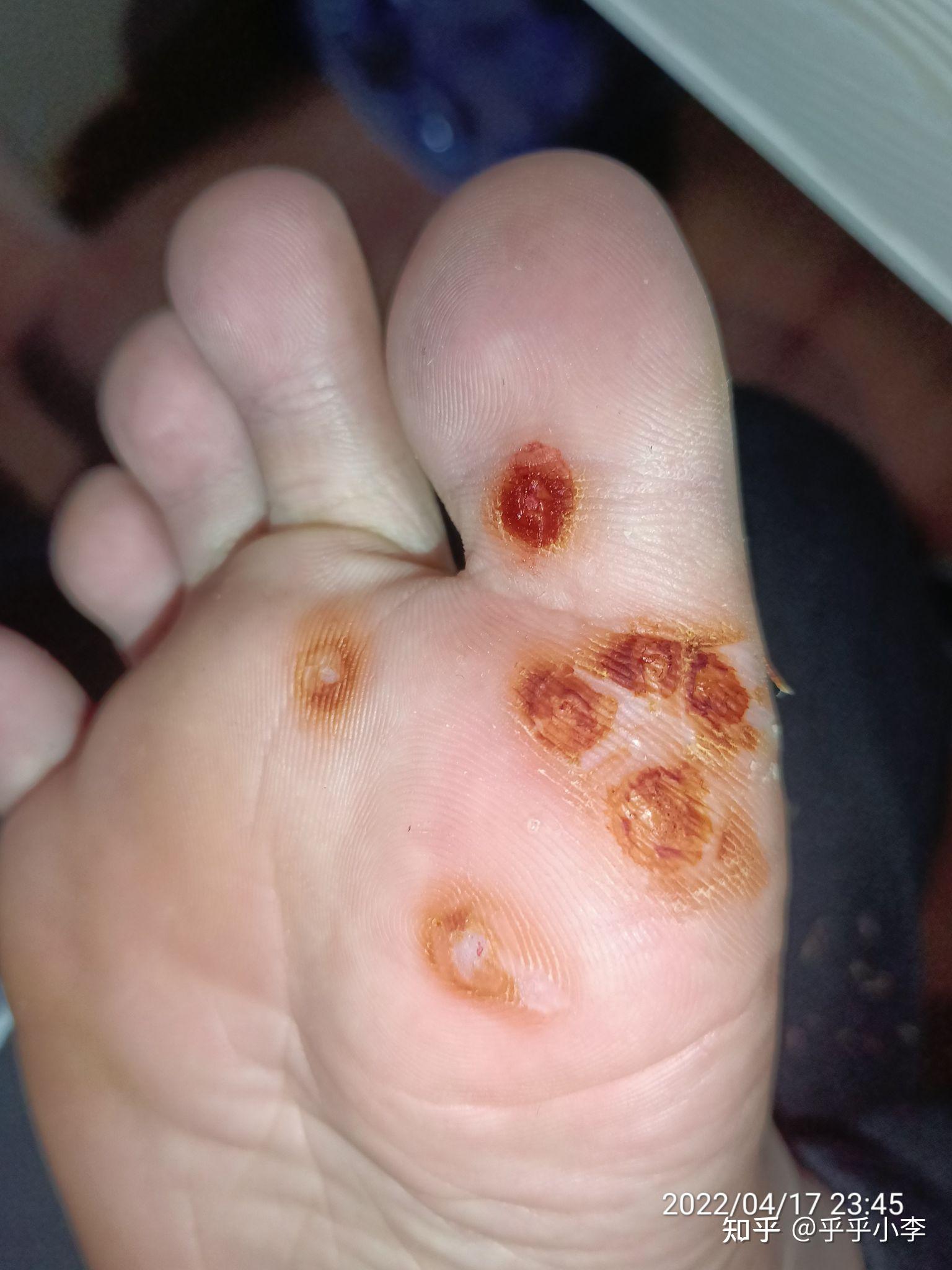 10%浓碘酊治疗跖疣 - 知乎