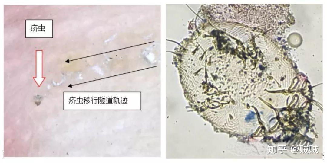 疥虫掘的隧道图片图片