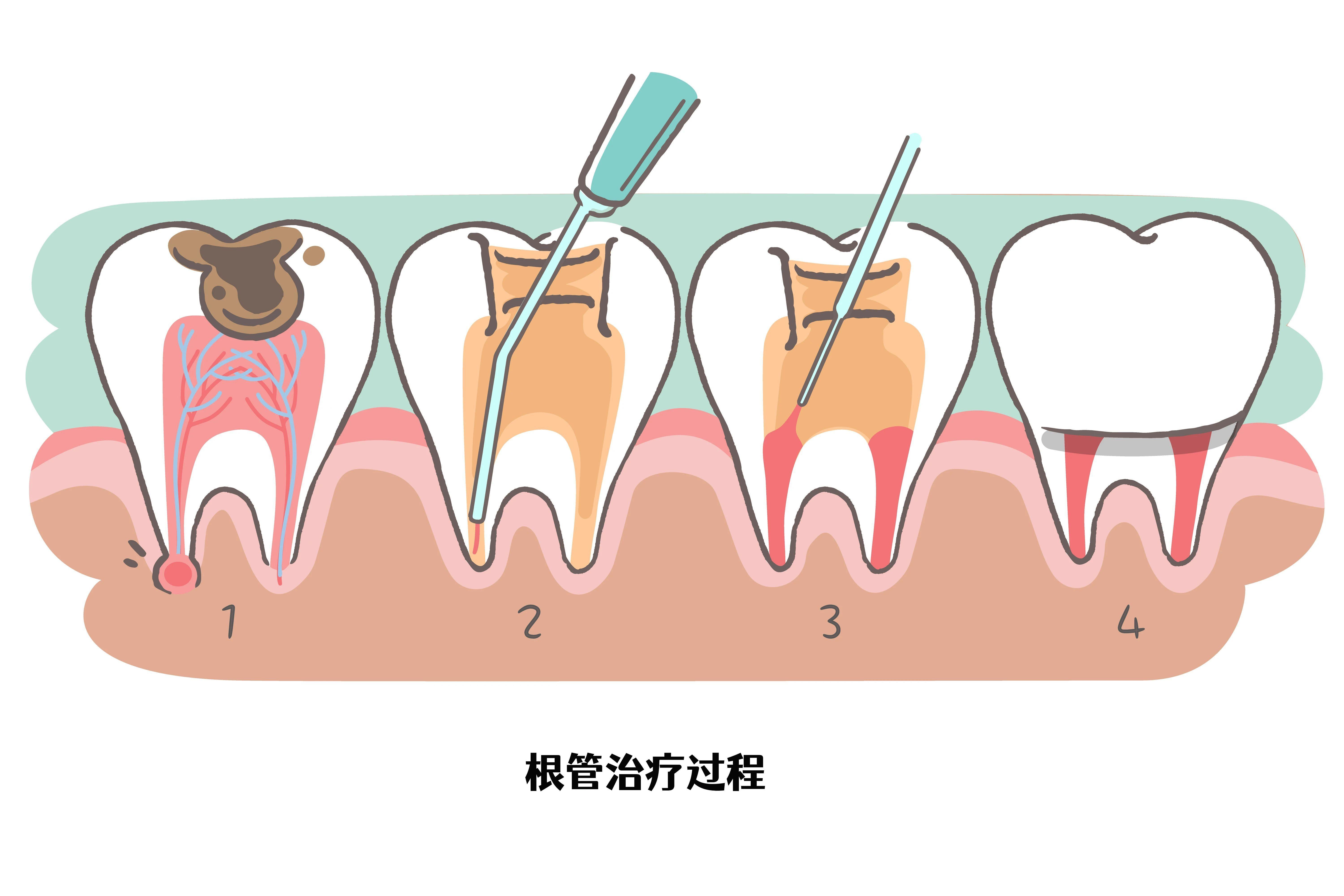 牙齿根管治疗图片步骤图片