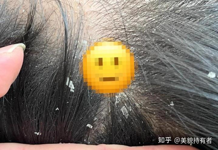 见过最大的头皮屑有多大? - 知乎