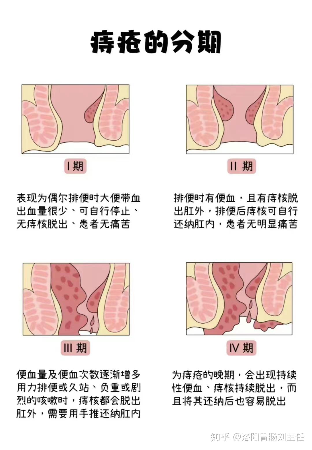 痔疮分期的症状图片图片