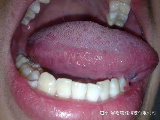 口腔念珠菌感染如何治疗