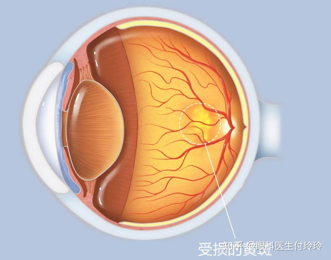 一组图让你亲眼感受近视散光白内障的视界