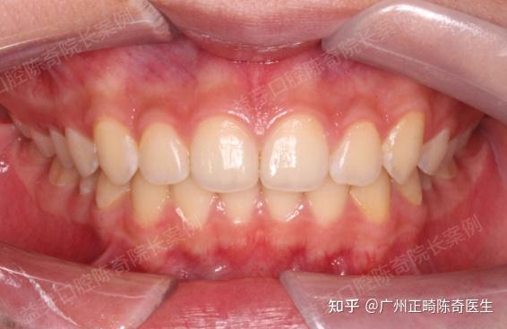 医生将8岁女孩恒牙当乳牙错拔还能再种回去吗