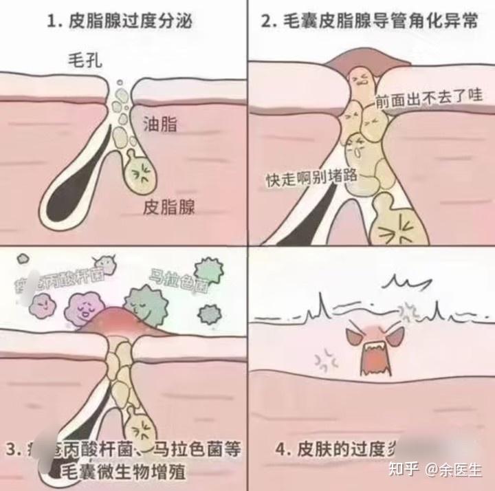 怎么让闭口爆出来? - 知乎