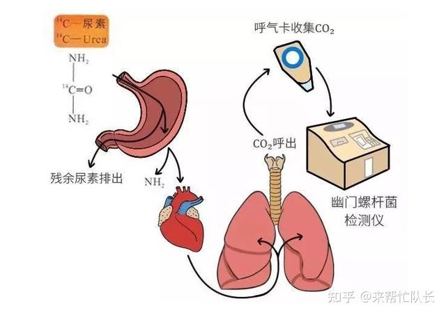 "吹气"检测幽门螺杆菌,也是指碳13或碳14尿素呼气试验,尿素呼气试验